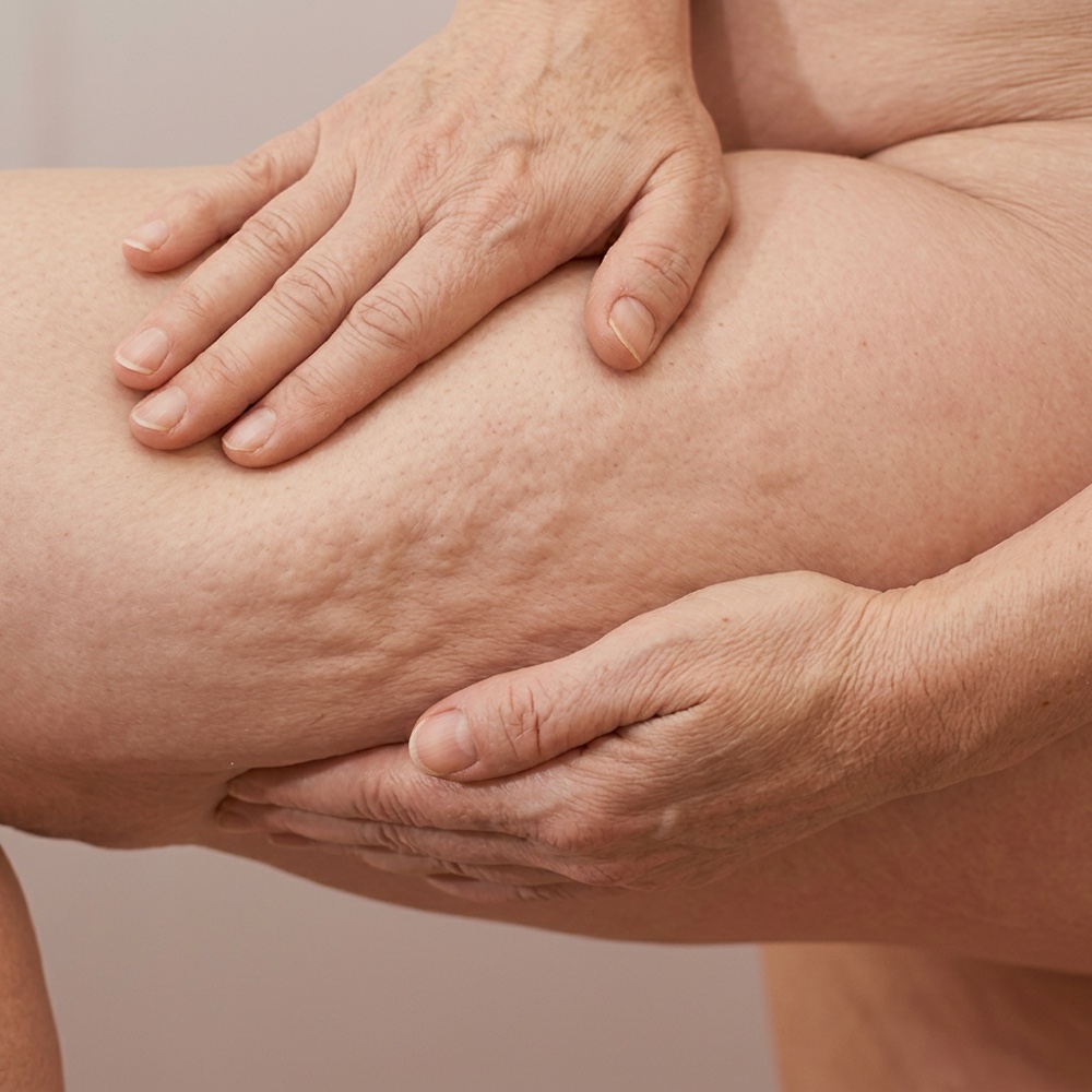 Hands pressing the skin of a thigh, showing dimpled cellulite texture